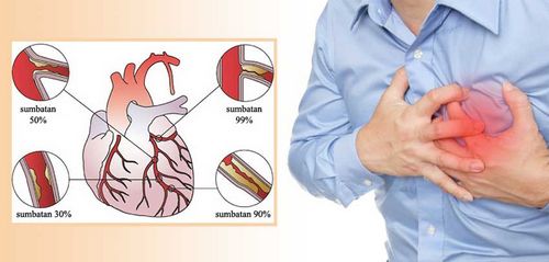 Gejala Serangan Jantung Dan Penyakit Arteri Koroner mengetahui apa saja risikonya